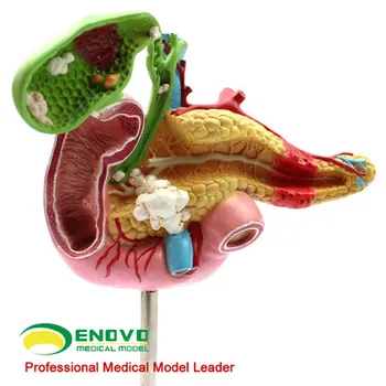 Патологическая модель поджелудочной железы, двенадцатиперстного и желчного пузырей, хирургическая модель пищеварительной системы с желчнокаменной болезнью 10*20*5.5 cm